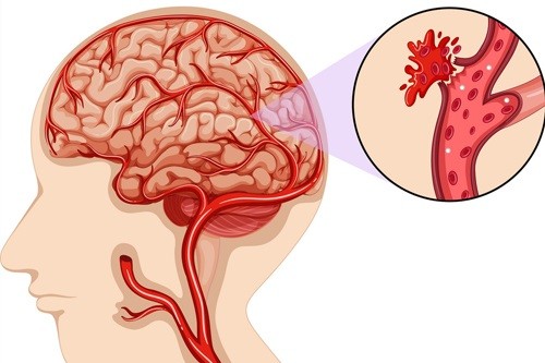 Tăng huyết áp làm tăng nguy cơ xảy ra tai biến mạch máu não (xuất huyết não và nhồi máu não) ở bệnh nhân