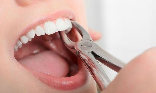 Niềng răng trong suốt có cần nhổ răng hay không tùy thuộc vào từng trường hợp cụ thể của bệnh nhân