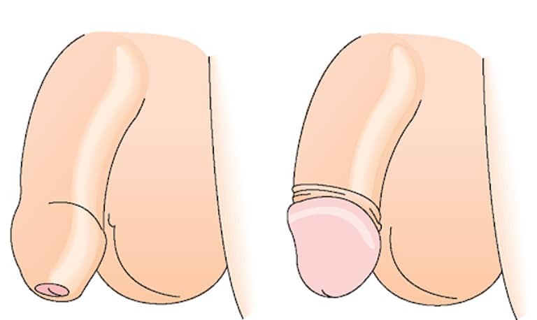 Hẹp bao quy đầu là tình trạng thường gặp ở trẻ nhỏ và thậm chí là cả người lớn (hình bên trái)