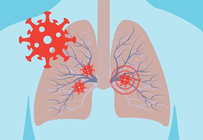 Hệ hô hấp của trẻ có thể bị virus, vi khuẩn xâm nhập gây các bệnh lý đường hô hấp