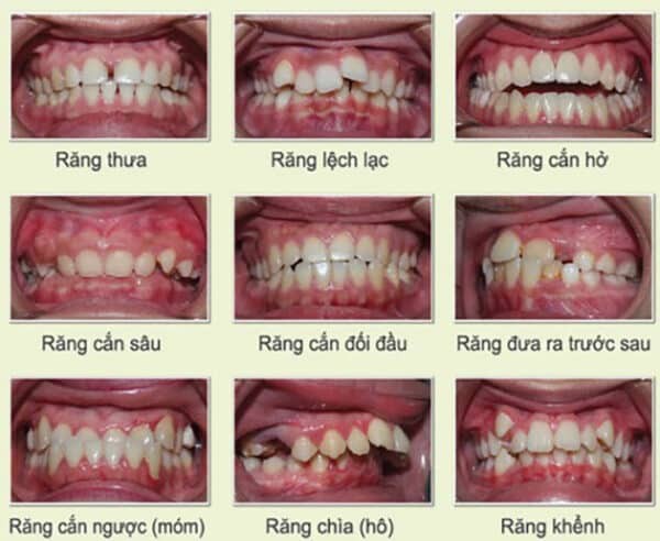 Những tình trạng răng nên sử dụng niềng răng trong suốt