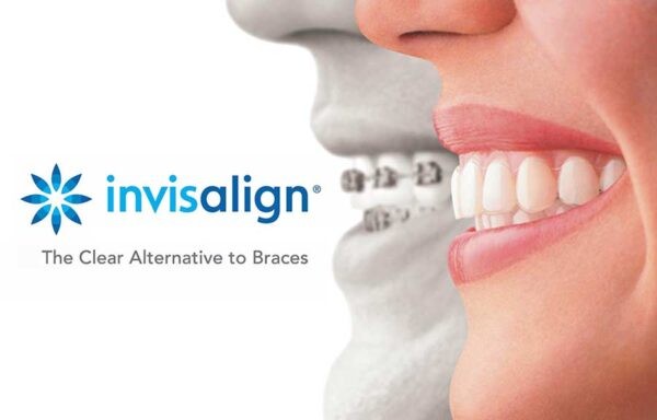 Ưu điểm lớn nhất của niềng răng Invisalign là khách hàng biết trước hiệu quả điều trị