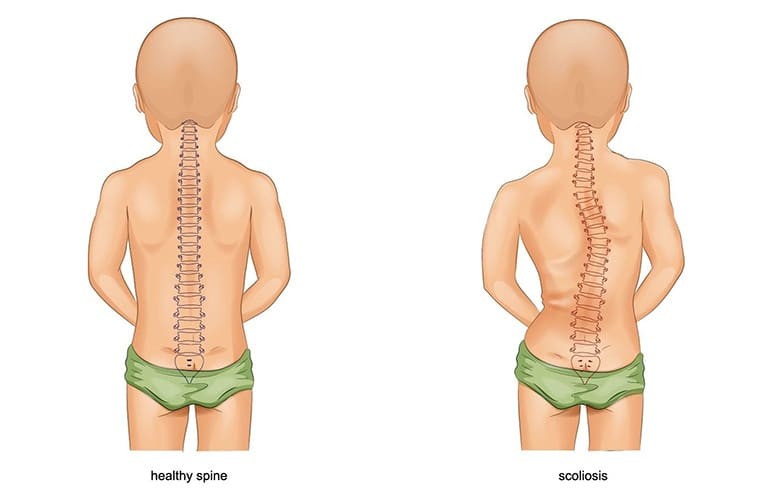 Phân biệt cột sống bình thường (healthy spine) và tình trạng vẹo cột sống ở trẻ (scoliosis)