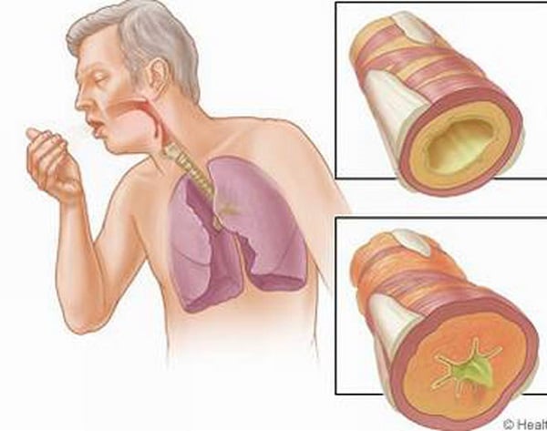 Co thắt phế quản có thể làm Hen nặng lên
