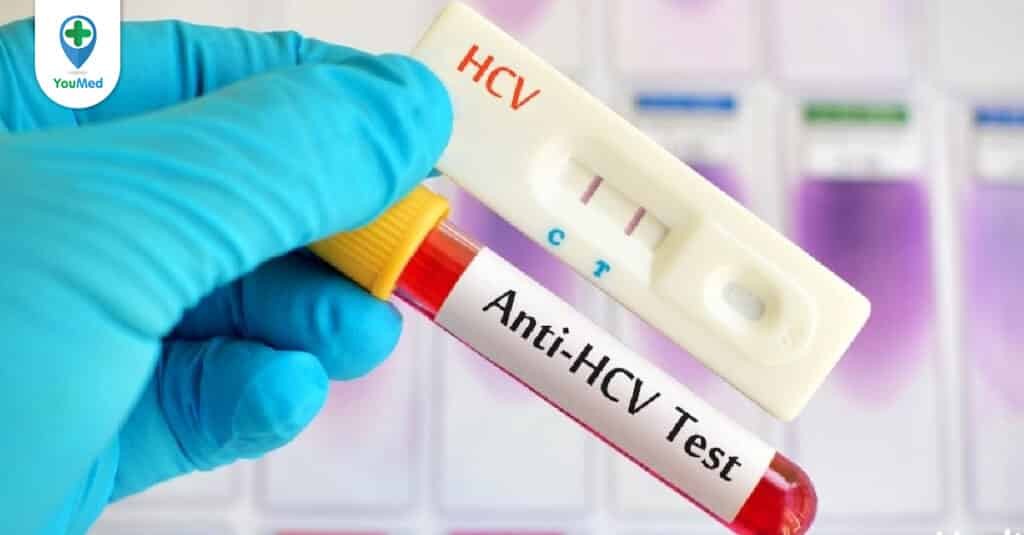 Xét nghiệm anti HCV nên thực hiện khi nào?