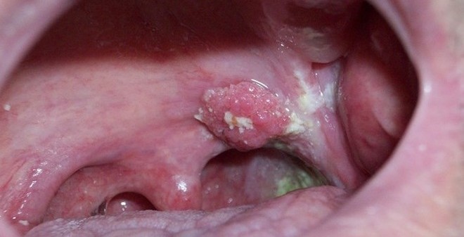 Ung thư vòm họng khó lường và nguy hiểm