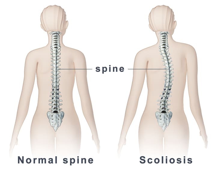 Phân biệt cột sống bình thường (Normal spine) và tình trạng vẹo cột sống sang một bên (Scoliosis)