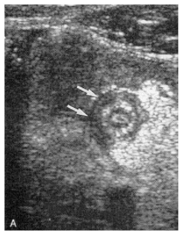 Hình ảnh siêu âm (mặt cắt ngang) mô tả viêm ruột thừa cấp. Cấu trúc giống hình bia do dày thành ruột thừa và thâm nhiễm mỡ khu trú xung quanh.