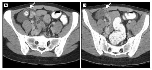 Viêm ruột thừa cấp. Hình ảnh vùng chậu (A và B) từ chụp CT ổ bụng có cản quang cho thấy ruột thừa dày thành (mũi tên) có sỏi phân và dịch xung quanh gợi ý tình trạng viêm.