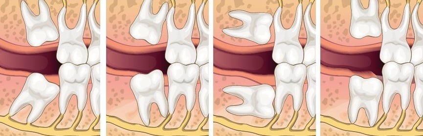 Các kiểu răng khôn mọc lệch gây đau nhức