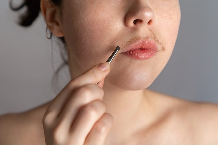Nguyên nhân chính gây rậm lông ở nữ giới là cường androgen