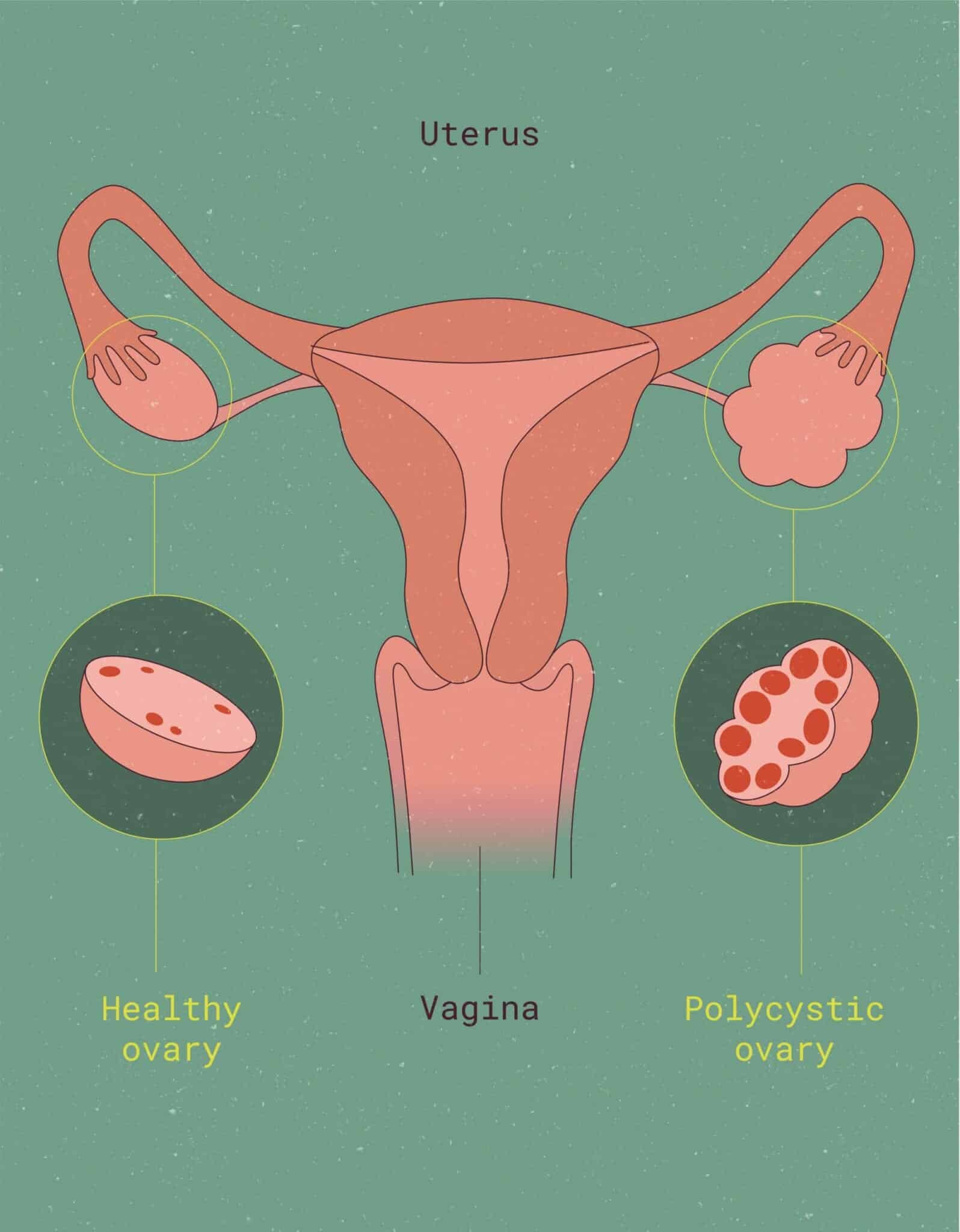 Hội chứng buồng trứng đa nang (Polycystic Ovary Syndrome) là nguyên nhân gây cường androgen phổ biến nhất ở phụ nữ