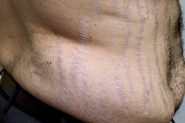 Các vết rạn da ở người bệnh mắc hội chứng Cushing