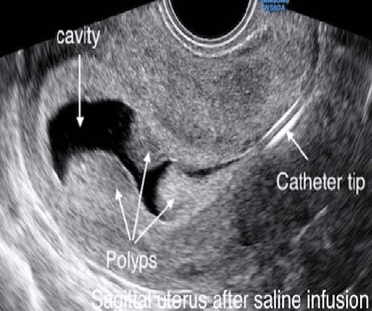 Hình ảnh siêu âm bơm nước vào buồng tử cung của đa polyp nội mạc tử cung 