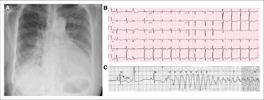 X-quang và điện tâm đồ (ECG) là những phương pháp được sử dụng để chấn đoán suy tim cấp