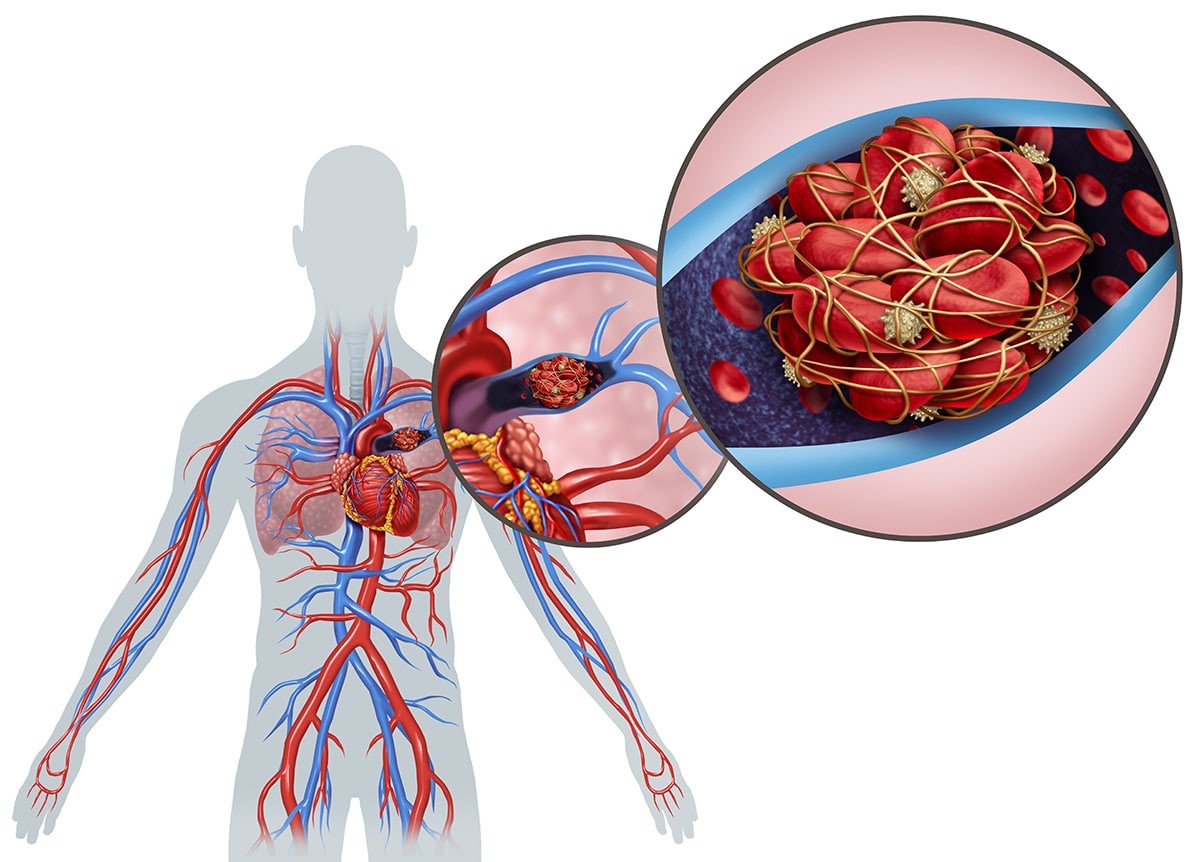 Thuyên tắc động mạch phổi là một trong những nguyên nhân gây ra suy tim cấp