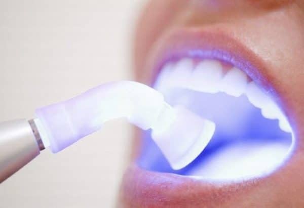 Tẩy trắng răng bằng đèn plasma sẽ không sinh nhiệt và có thể dùng tại nhà