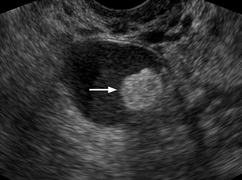 Hình ảnh siêu âm của u bì buồng trứng, phản âm dày sáng (vị trí mũi tên)