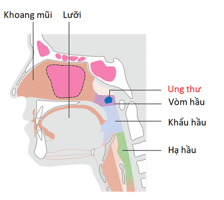 Giải phẫu vùng hầu: ung thư vòm họng (hay vòm hầu), xảy ra ở vị trí 1/3 trên của vùng hầu (màu tím)