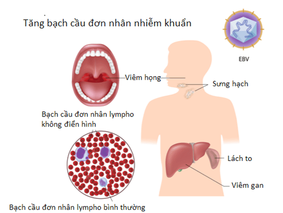 Tăng bạch cầu đơn nhân nhiễm khuẩn do nhiễm EBV với các triệu chứng: viêm họng, sưng hạch, lách to, viêm gan