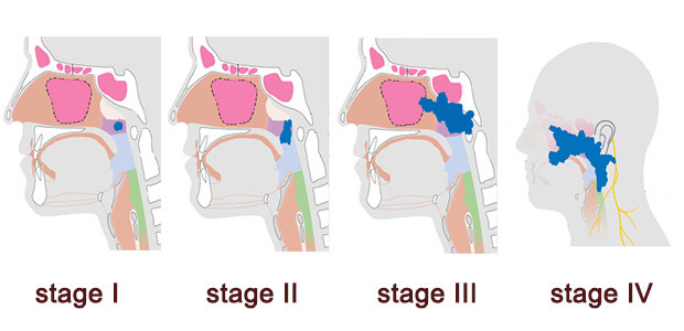 Sự phát triển của khối u vòm họng qua từng giai đoạn (Từ trái sang: giai đoạn I - IV)