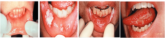 Các mức độ viêm niêm mạc miệng do xạ trị