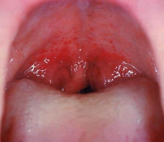 Chấm xuất huyết thành sau họng trong viêm họng do liên cầu tiêu huyết beta nhóm A.