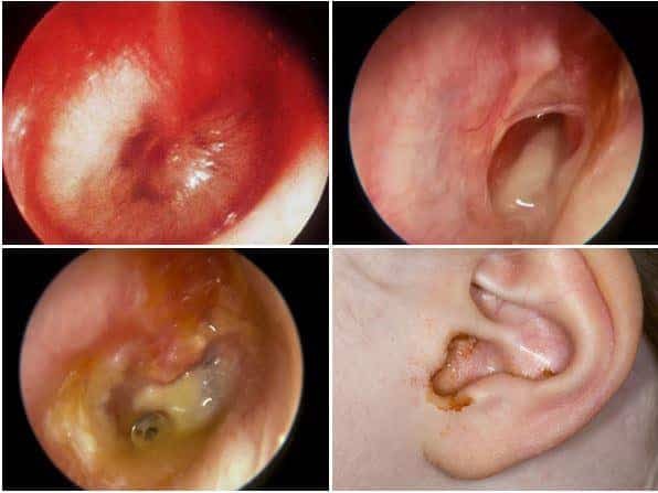 Một số hình ảnh nội soi viêm tai giữa mủ