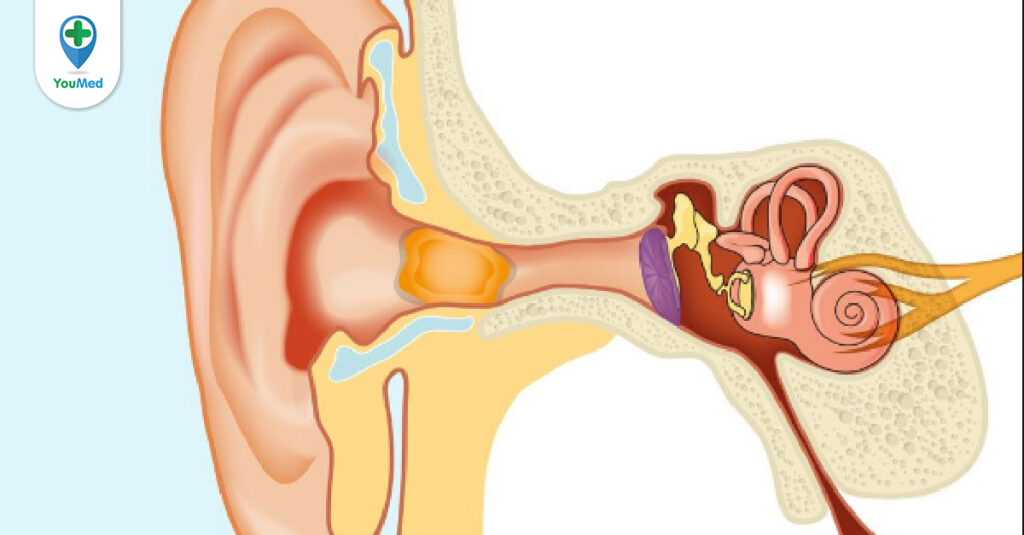 Cholesteatoma: nguyên nhân, triệu chứng, cách điều trị và phòng ngừa