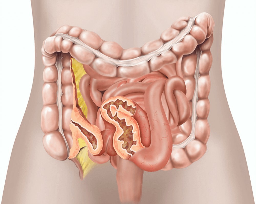 Crohn có nguy cơ tổn thương ruột