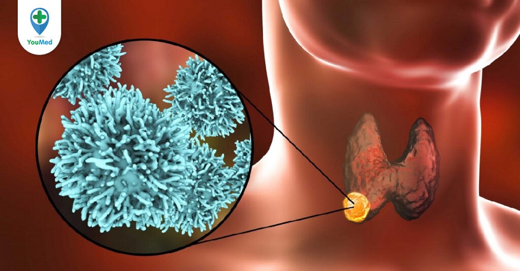 Ung thư tuyến giáp di căn hạch: nguyên nhân, dấu hiệu, cách điều trị