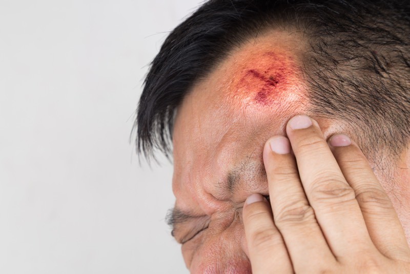 Đái tháo nhạt trung ương có thể xảy ra sau khi người bệnh bị chấn thương ở đầu
