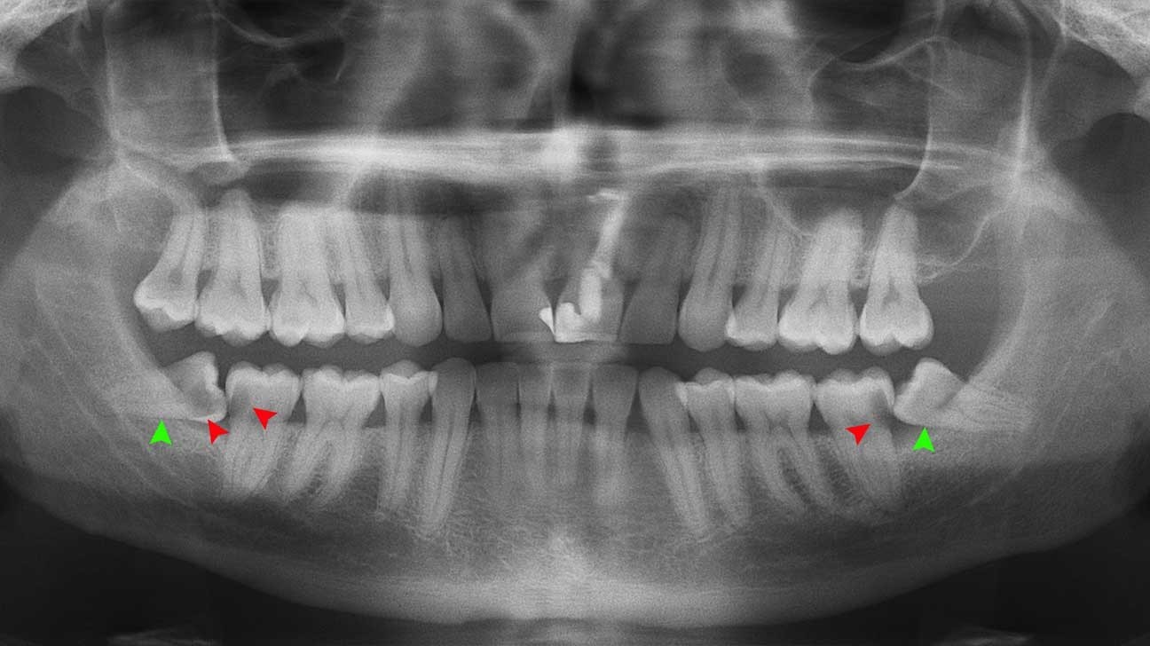Hình ảnh X-quang sẽ giúp nhận biết răng khôn có mọc lệch hay không