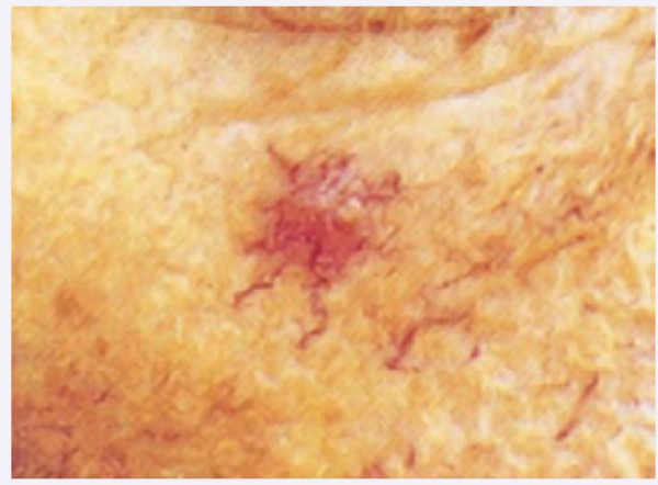 Hình ảnh dấu sao mạch. Ảnh gốc từ: Marks R. Skin Disease in Old Ages. Philadelphia: JB Lippincott, 1987.
