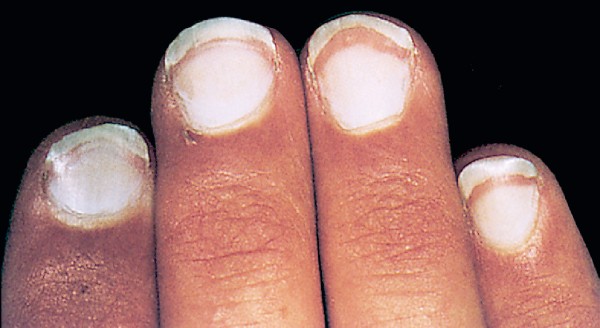 Hình ảnh móng trắng (Terry’s nails) Ảnh gốc từ: Habif TP, Clinical Dermatology, 5th edn, Philadelphia: Mosby, 2009: Fig 25-44.