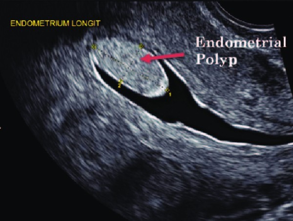 Hình ảnh polyp lòng tử cung, vị trí nằm ở đáy tử cung qua siêu âm bơm nước