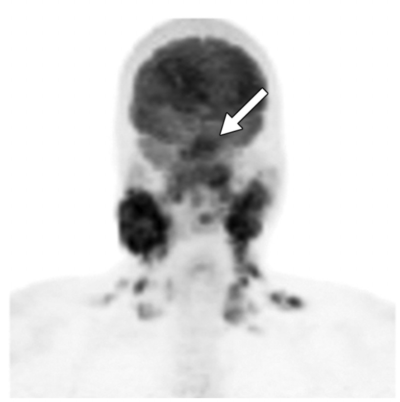 Hình chụp PET của một bệnh nhân nam 25 tuổi được chẩn đoán ung thư vòm họng với nhiều tín hiệu tăng hấp thu phóng xạ ở vùng vòm họng, hạch cổ 2 bên hạch trên đòn