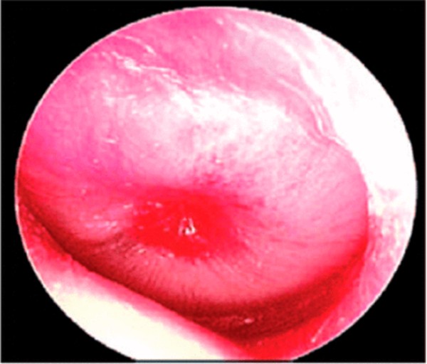Hình ảnh màng nhĩ xung huyết, căng phồng trong viêm tai giữa cấp