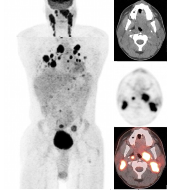 Hình chụp PET/CT của một bệnh nhân nam 30 tuổi mới được chẩn đoán ung thư vòm họng. Hình ảnh ghi nhận tăng hấp thu FDG (SUV max 10,2) u vùng vòm họng bên trái, với những ổ di căn tăng hoạt động chuyển hoá ở hạch cổ, hạch trung thất.