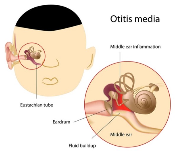 Viêm tai giữa xảy ra khi có tình trạng sưng tấy và tích tụ dịch trong tai giữa, vùng phía sau màng nhĩ.