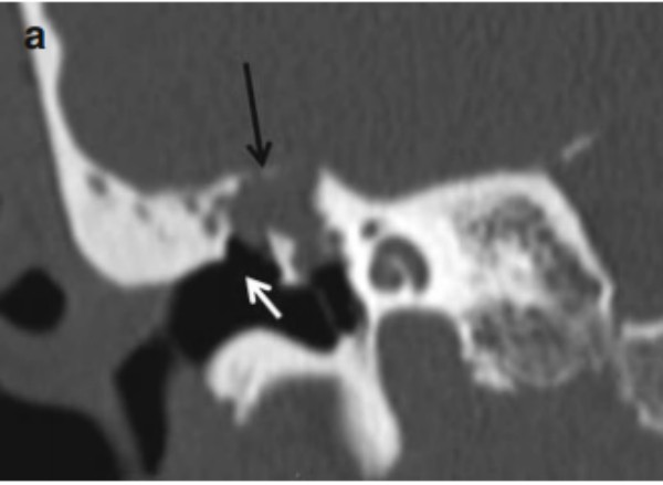Hình ảnh coronal trên phim CT xương thái dương cho thấy khối cholesteatoma vùng thượng nhĩ (mũi tên đen) làm mờ cấu trúc scutum (mũi tên trắng). Khối cholesteatoma ăn mòn cấu trúc trần hòm nhĩ. (Nguồn: Chronic otitis media - Manual of head and neck imaging, Springer)