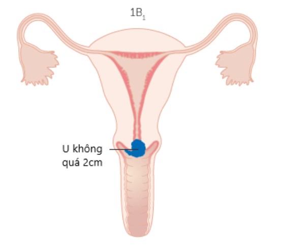 Hình minh họa ung thư cổ tử cung giai đoạn 1B1