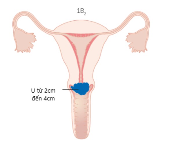 Hình: Ung thư cổ tử cung giai đoạn 1B2