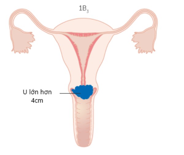 Hình minh họa ung thư cổ tử cung giai đoạn 1B3