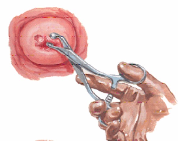 Hình minh họa quá trình sinh thiết tổn thương cổ tử cung