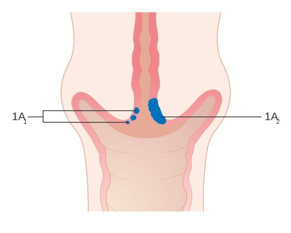 Hình minh họa ung thư cổ tử cung giai đoạn đầu 1A