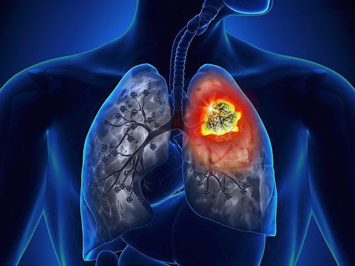 Một khối u ở thùy trên phổi (T)