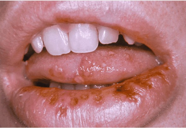Loét miệng trong nhiễm HSV