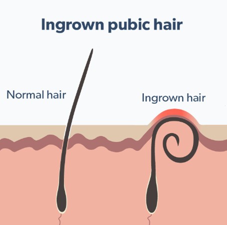 Lông mọc ngược (Ingrown hair) vùng mu khá phổ biến, và gây nhiều phiền toái cho giới nữ…