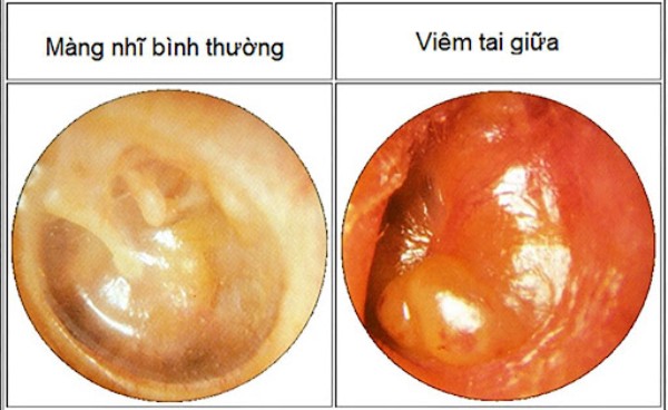Hình ảnh màng nhĩ bình thường và màng nhĩ trong viêm tai giữa
